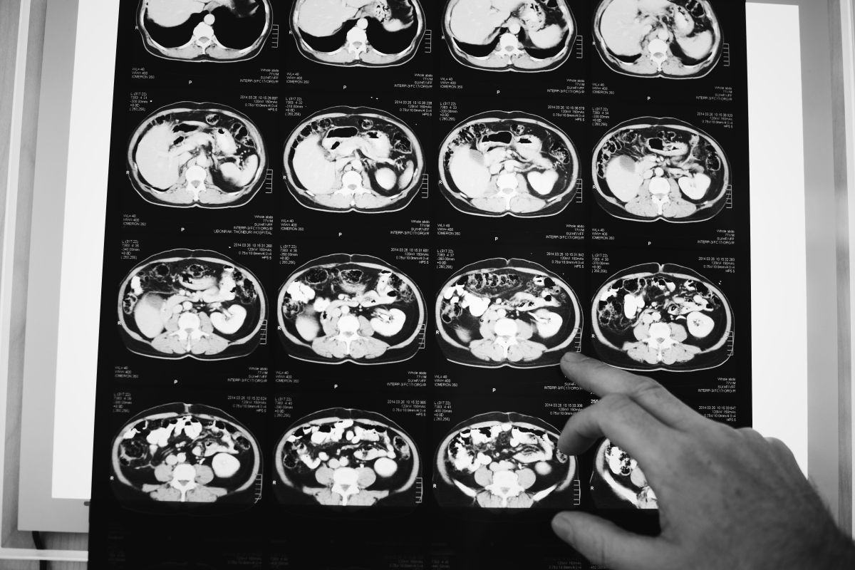 Neuro Surgery
