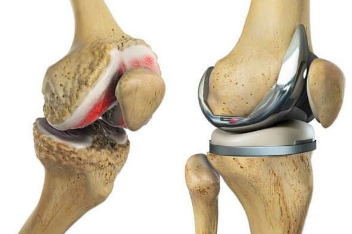 Conventional Hip & Knee Replacement